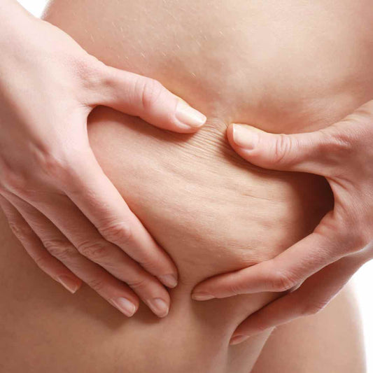 Cellulite : pourquoi elle est normale et ne définit pas ta beauté ?